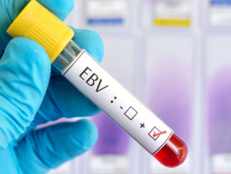 Epigenetic Modification DA Hydroxymethylation (5-hmC) Impact EBV Virus Gene Expression