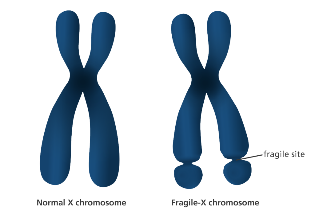 fragile x chromosome and normal chromosome