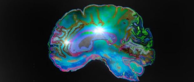 epigenetic mri brain