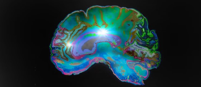 epigenetic mri brain