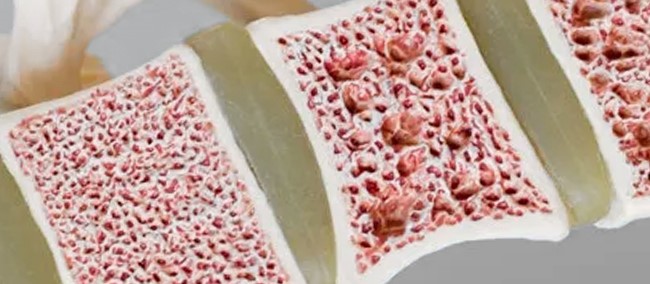 bone cancer epigenetics